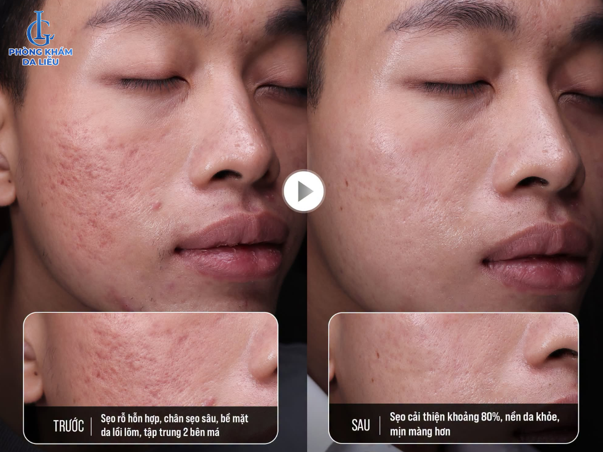 Hình ảnh trước và sau khi điều trị sẹo rỗ tại Phòng khám Da liễu LG Clinic