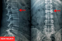 Tin tức sức khỏe - 3 tư thế ngủ tốt nhất giúp giảm đau rõ rệt cho người bị thoái hóa cột sống, thoát vị đĩa đệm