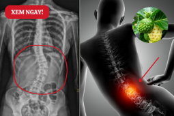Tin tức sức khỏe - Ngồi lâu đau nhức muốn “gãy lưng”, đau âm ỉ mãi không dứt – Đừng bỏ qua mẹo đơn giản này!