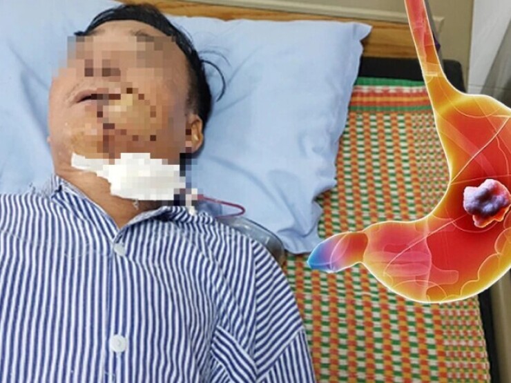 Người đàn ông 50 tuổi bàng hoàng phát hiện ung thư sau thời gian dài hôi miệng