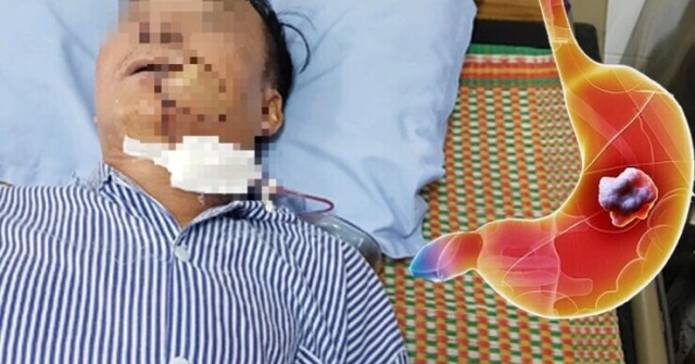 Người đàn ông 50 tuổi bàng hoàng phát hiện ung thư sau thời gian dài hôi miệng