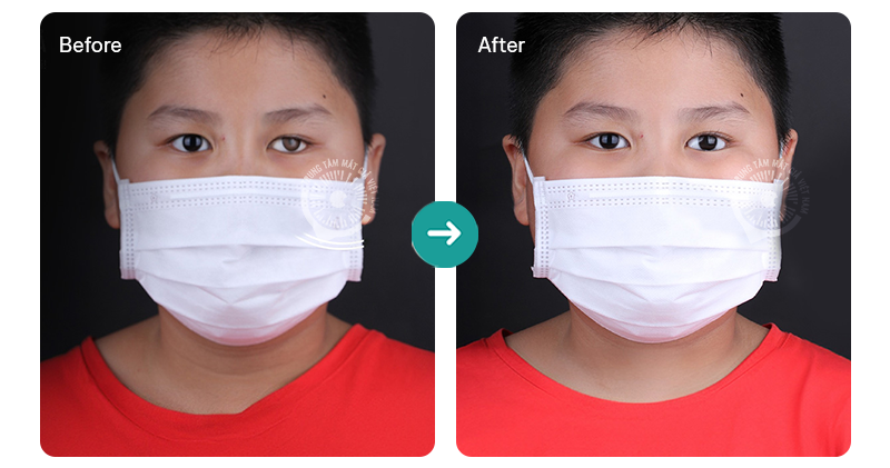 Một trường hợp thay thế mắt giả có sẵn bằng mắt cá nhân 3D