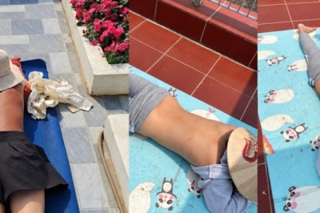 Sau 'chanh liều cao' lại xuất hiện hội 'thích phơi nắng': Cẩn thận ung thư da